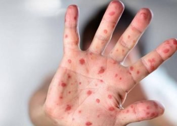 Pemprov DKI Bentuk Tim Tracing Kasus Cacar Monyet