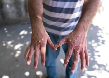 RI Waspada, Malaysia Kembali Laporkan Kasus Mpox