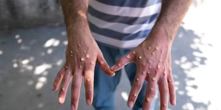 RI Waspada, Malaysia Kembali Laporkan Kasus Mpox