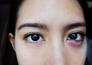 batas-waktu-mata-bintitan-sembuh